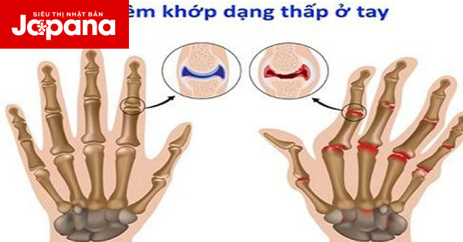 Phân biệt viêm khớp dạng thấp và viêm khớp thông thường để có phương pháp điều trị hiệu quả