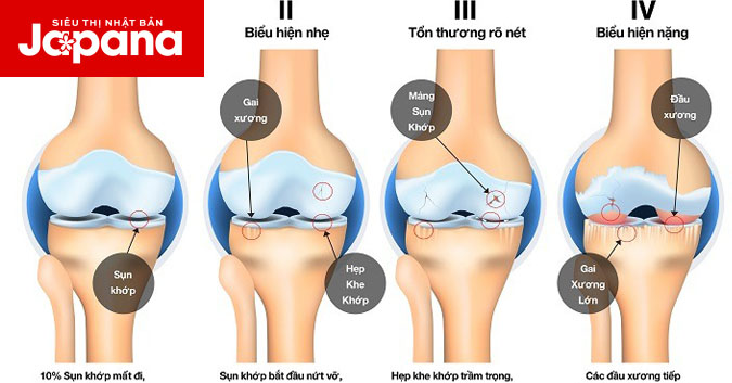 4 giai đoạn chính của bệnh thoái hoá khớp và lưu ý khi điều trị