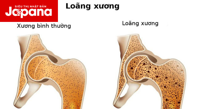 5 ngộ nhận sai lầm về loãng xương khiến bệnh trầm trọng hơn