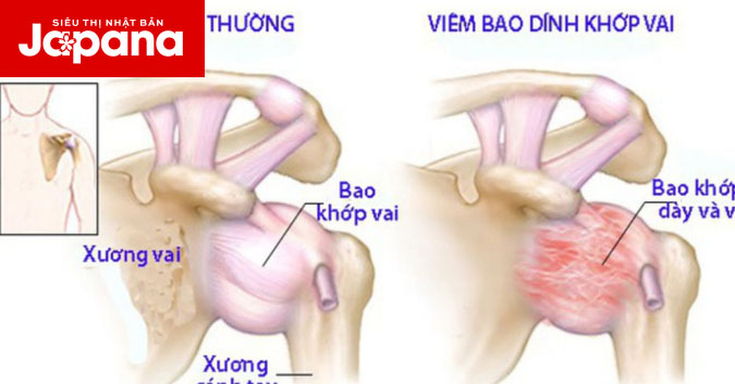 Dấu hiệu nhận biết và cách điều trị viêm dính bao khớp vai