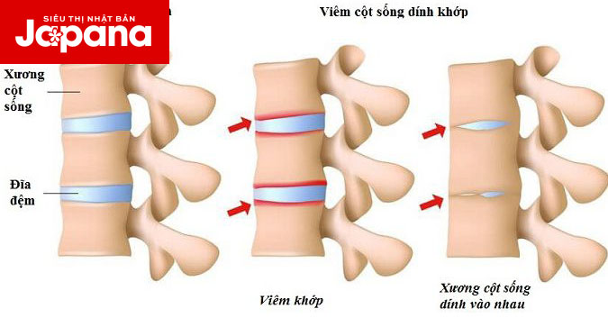 Triệu chứng và cách điều trị viêm cột sống dính khớp