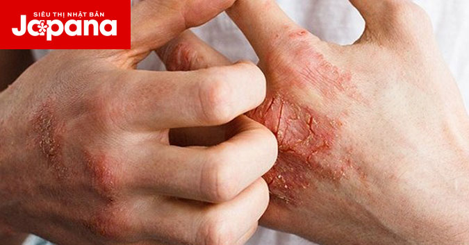 3 thông tin về viêm khớp vảy nến người bệnh nhất định cần phải biết