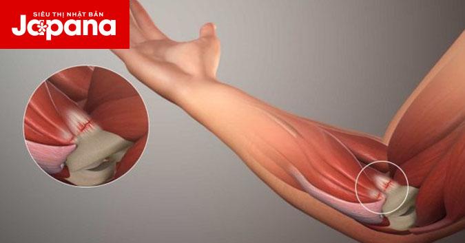 Đừng nên xem thường những cơn đau khớp khuỷu tay