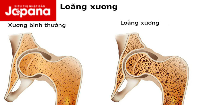 Vấn đề loãng xương và cách điều trị đúng cách