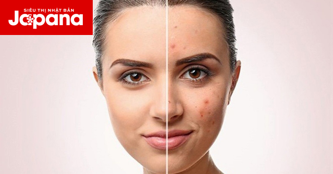 Xua tan nỗi lo thâm sẹo với bí quyết này