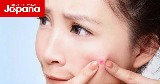 Bí quyết nặn mụn không làm thâm sẹo cho da