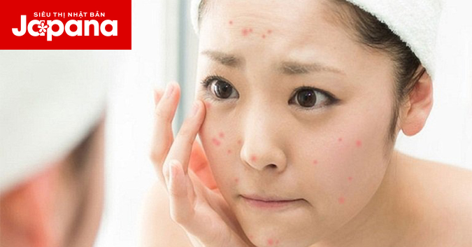 Tuyệt chiêu trị mụn tại nhà cho phái đẹp