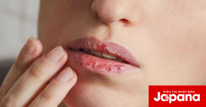 Bật mí những cách chữa trị hiệu quả khi bị dị ứng son môi