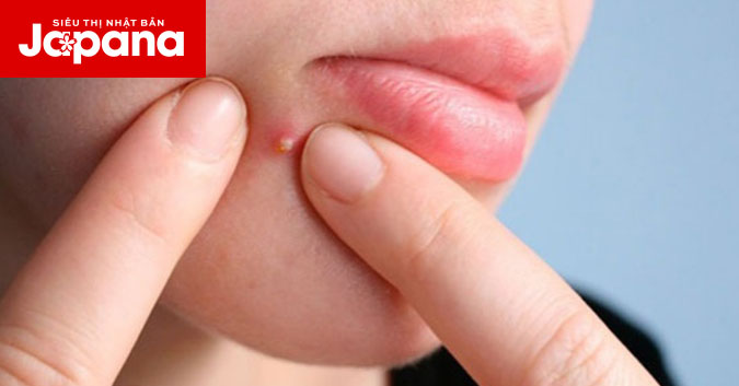 Cần tránh những sai lầm sau đây nếu không muốn làn da bị mụn viêm mãi không khỏi