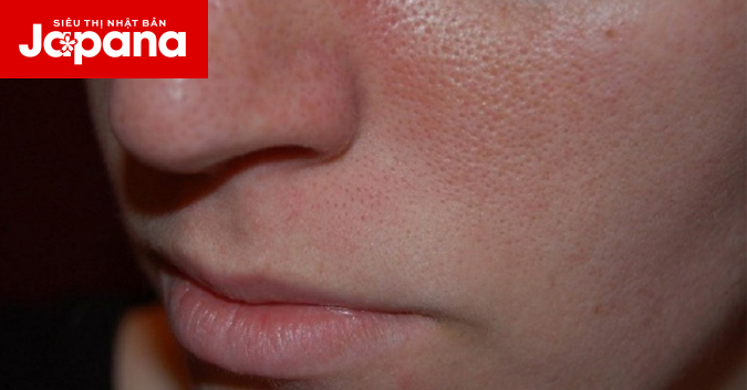 Da có lỗ chân lông to nên chăm sóc thế nào?