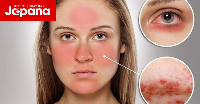Khám phá mẹo trị mụn cho da nhạy cảm đơn giản và hiệu quả