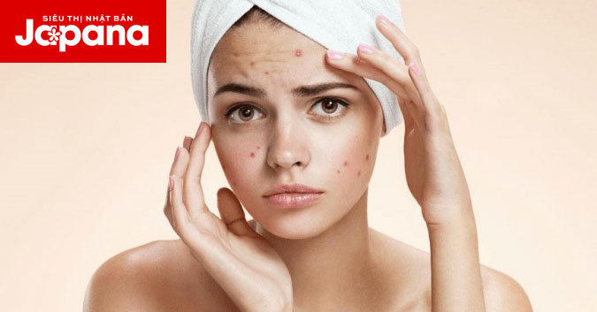 5 chiến thuật dưỡng da mụn hiệu quả mà các nàng nên áp dụng mỗi ngày