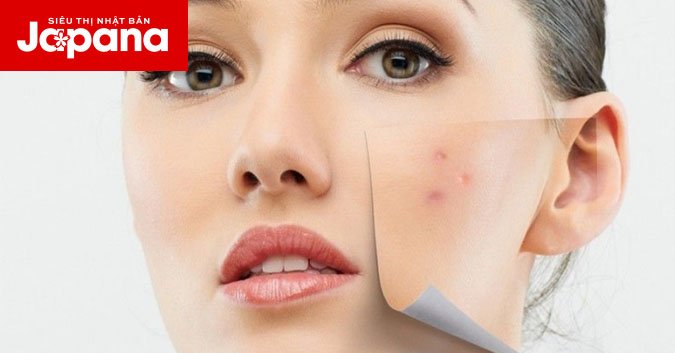 Nguyên liệu thiên nhiên trị thâm mụn tại nhà có hiệu quả như lời đồn