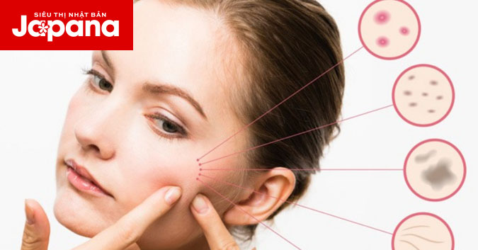 Những nguyên tắc vàng trị mụn thâm bạn cần biết rõ