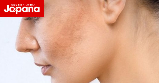 Gợi ý một số mặt nạ từ thiên nhiên giúp thổi bay da khô nám
