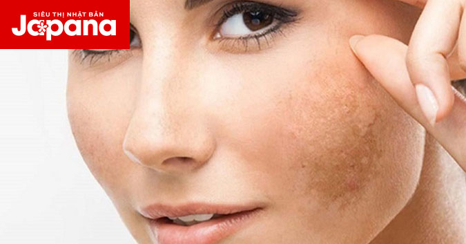 Nguyên nhân nào khiến da bị nám đen và cách để cải thiện?