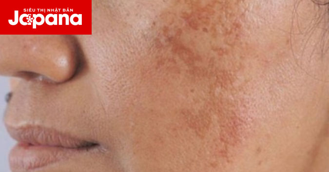 Mách bạn cách chăm sóc da bị nám mảng giúp bạn tự tin hơn