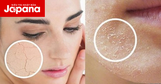 Dấu hiệu nào cho thấy da thiếu ẩm và cách chăm sóc