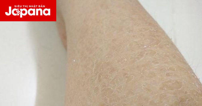 Đi tìm nguyên nhân khiến da khô nứt nẻ như da rắn và cách cải thiện