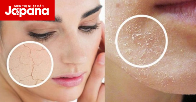 Bí quyết sử dụng nha đam cải thiện tình trạng da bị tróc vảy