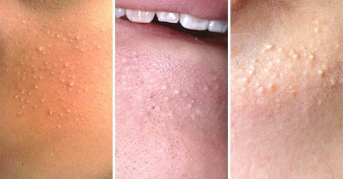 Mụn đầu trắng là gì? Nguyên nhân và cách chữa trị hiệu quả tại nhà