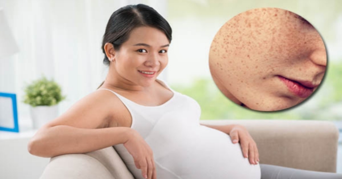 Cách trị nám da dân gian dành giúp mẹ bầu xinh đẹp suốt thai kỳ