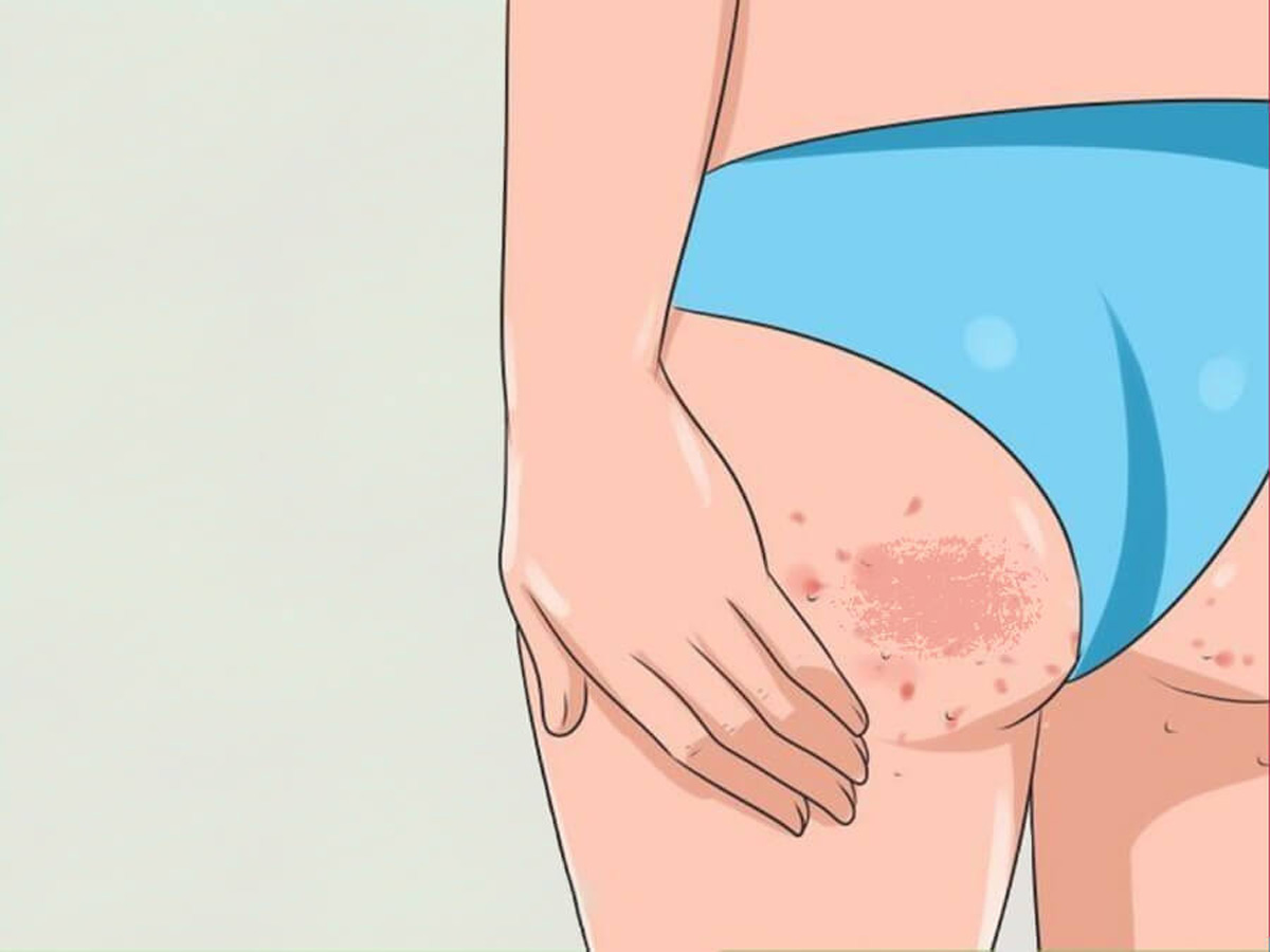 Cách trị thâm mông và thâm vùng kín hiệu quả ngay tại nhà