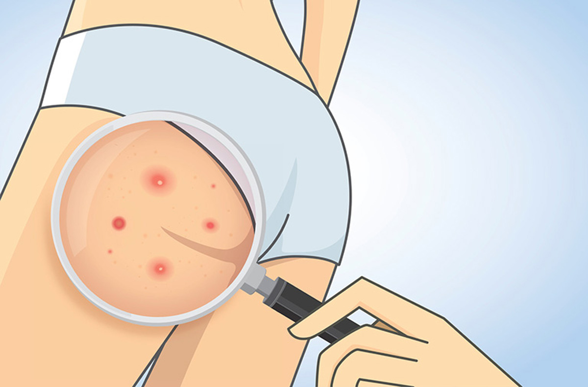 Bỏ túi ngay cách trị thâm khe mông hiệu quả tại nhà cực đơn giản
