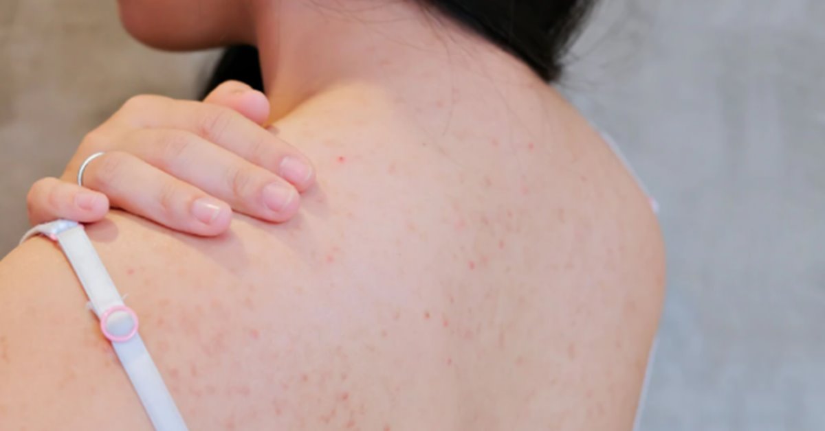 Top các dòng xà phòng tắm trị mụn lưng tốt nhất 2022
