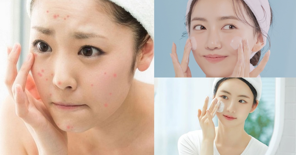 Hành trình phục hồi da mụn với mỹ phẩm Nhật Bản