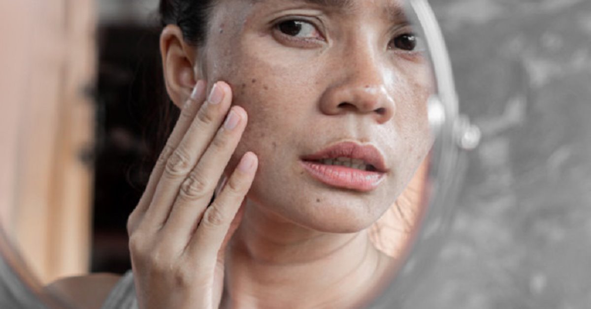Da bị nám nhẹ phải làm sao để cải thiện nhanh chóng?