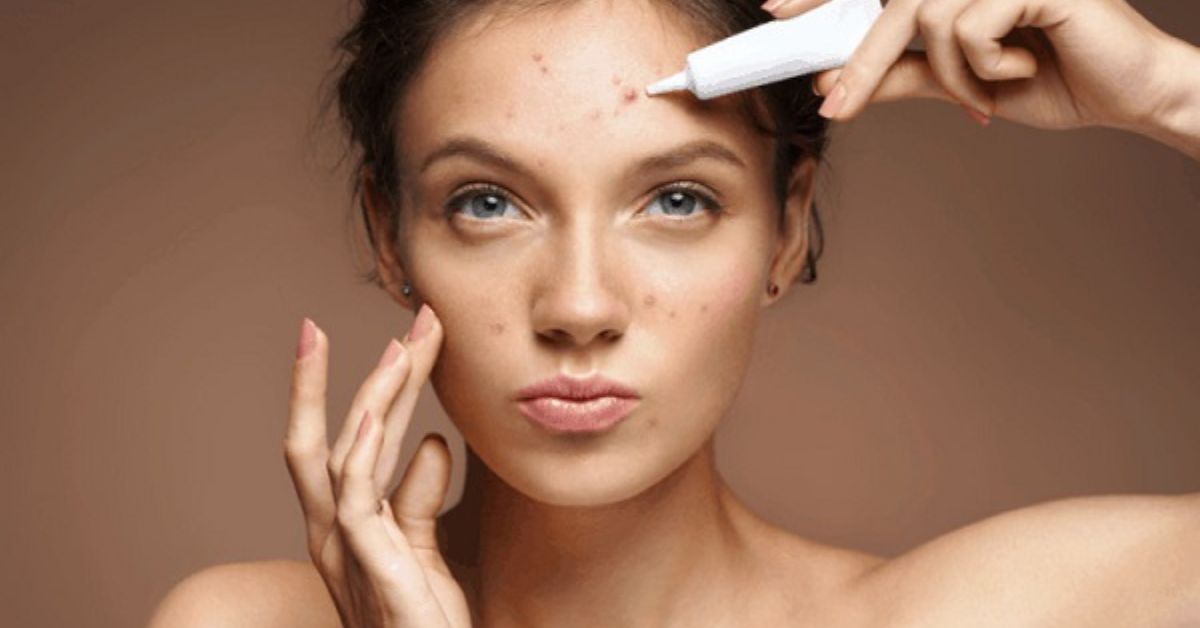 Sau khi nặn mụn nên skincare như thế nào?