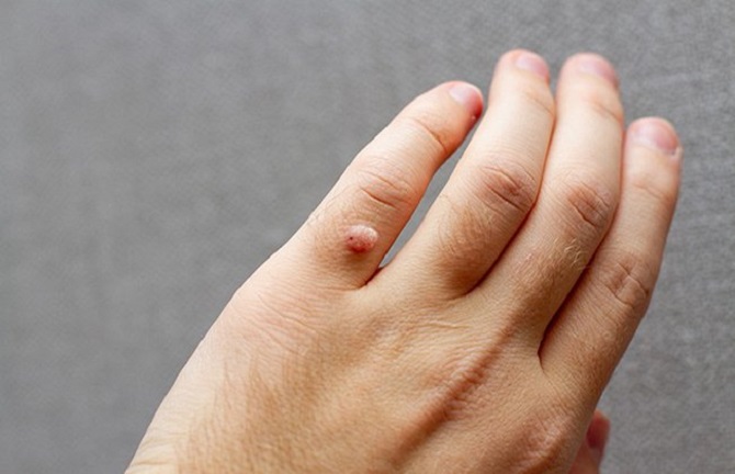 Cách trị mụn cóc ở tay tại nhà hiệu quả nhanh nhất