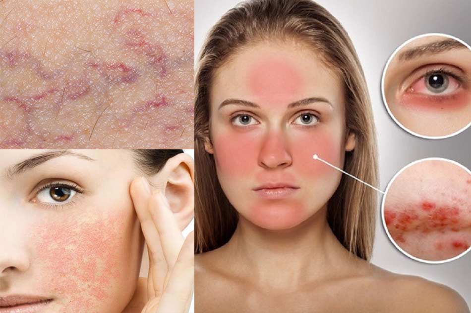 Serum dưỡng trắng da mặt cho da nhạy cảm nên sử dụng loại nào?
