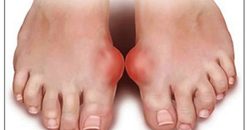 Các loại viên uống điều trị Gout của Nhật tốt nhất hiện nay