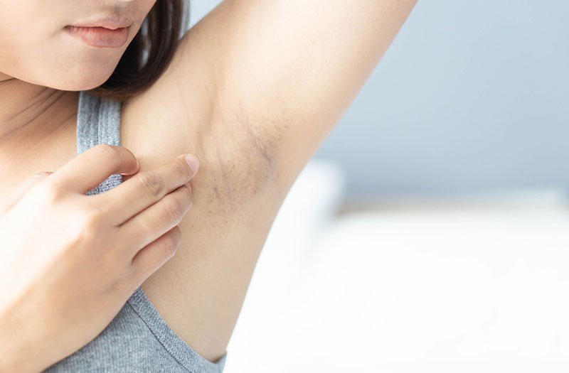 TOP viên uống trị thâm nách của Nhật tốt nhất hiện nay
