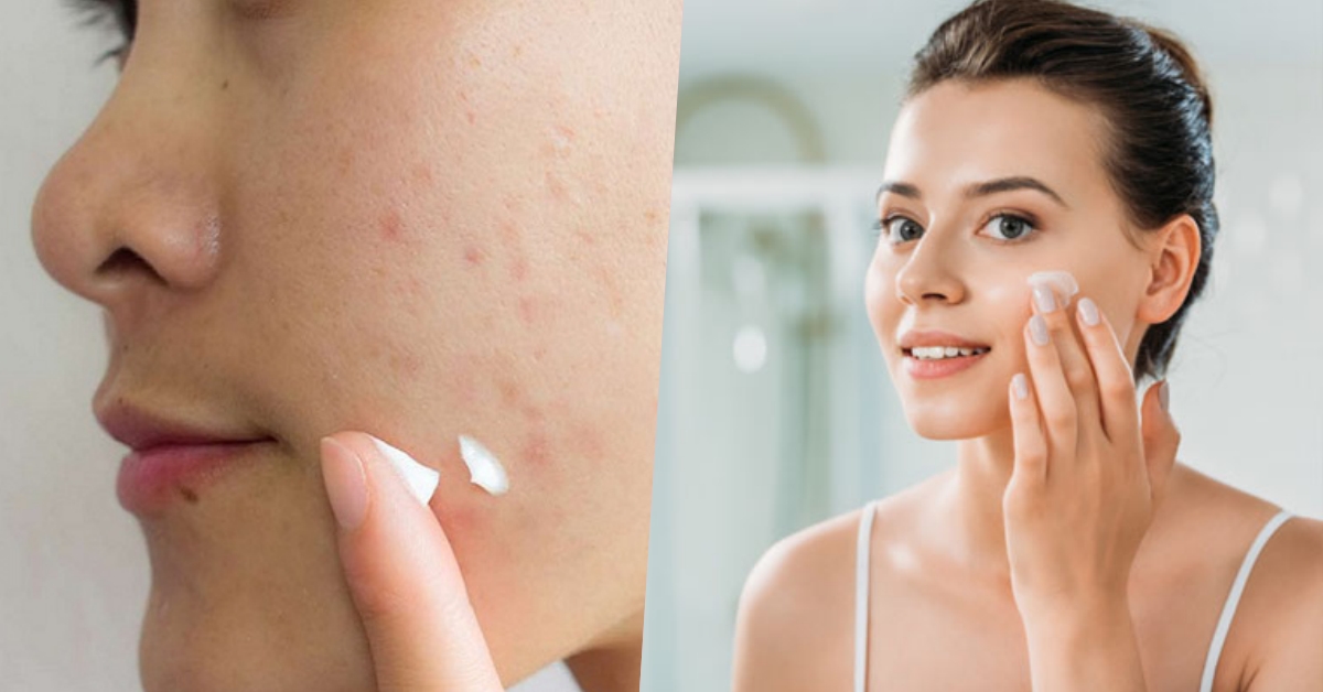 Nên bôi kem trị sẹo trước hay sau kem chống nắng?