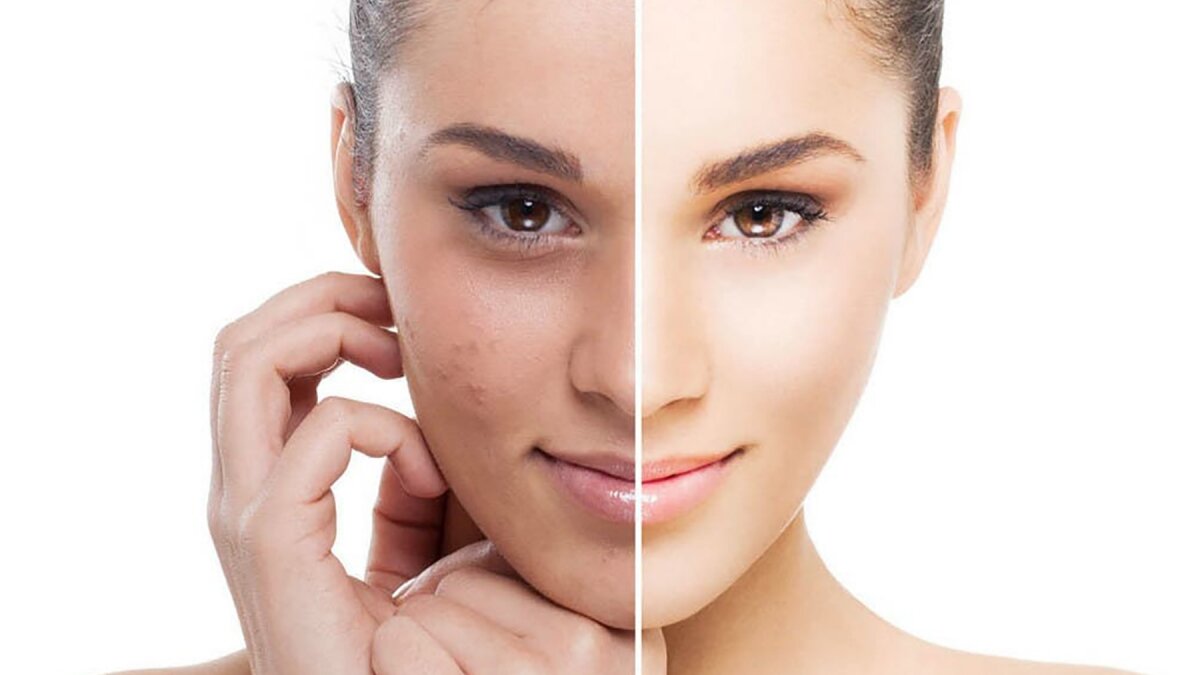 Cách trị nám nhẹ 2 bên gò má tại nhà