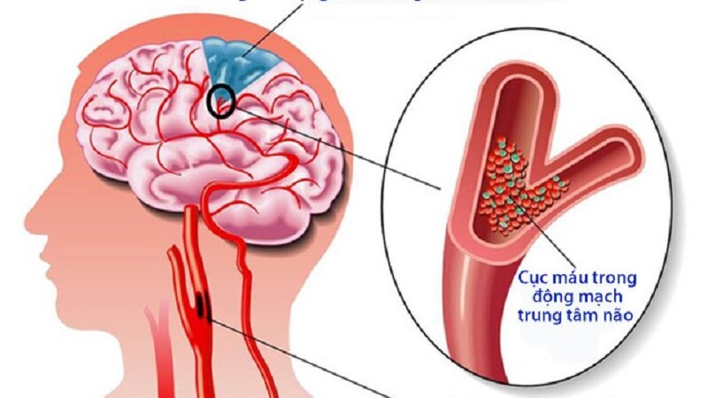 Cách phòng chống đột quỵ tai biến mạch máu não hiệu quả