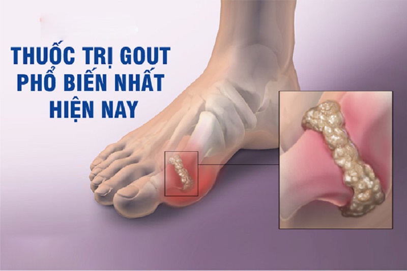 Bị Gút nên uống viên uống gì hiệu quả nhanh nhất?
