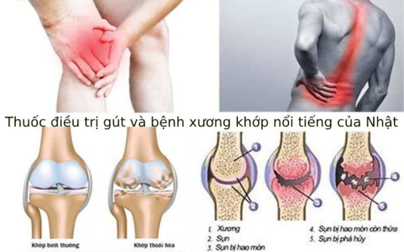 Viên uống điều trị gút và các bệnh xương khớp nổi tiếng của Nhật 