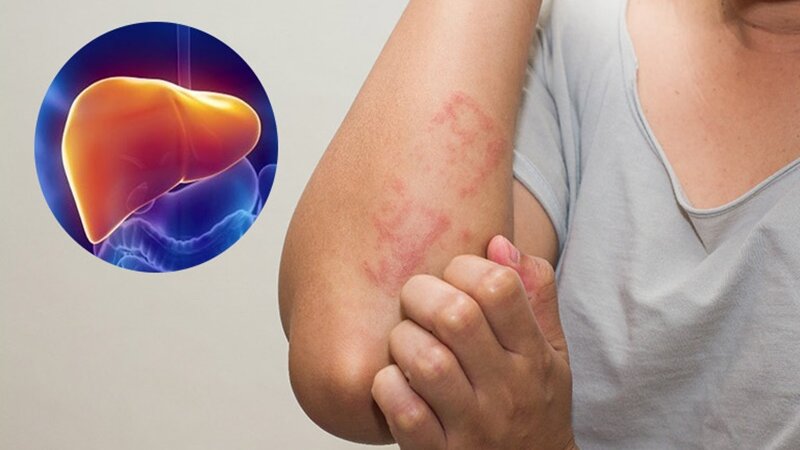 9 Dấu Hiệu Gan Không Tốt Và Nguyên Nhân Gan Có Vấn Đề