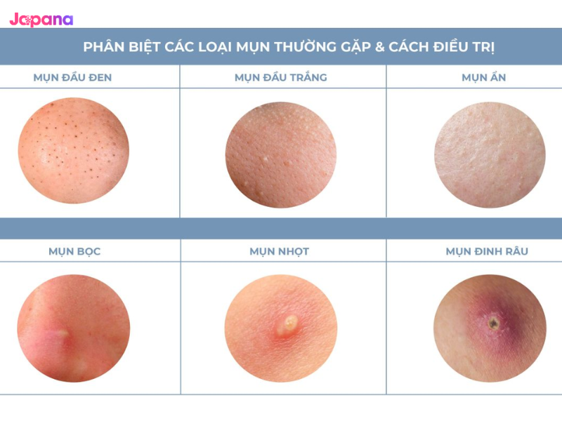 các loại da mụn