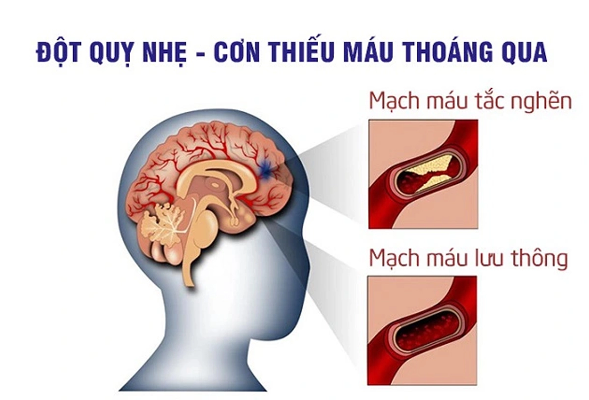 Đừng Chủ Quan Với Cơn Thiếu Máu Não Thoáng Qua (TIA)