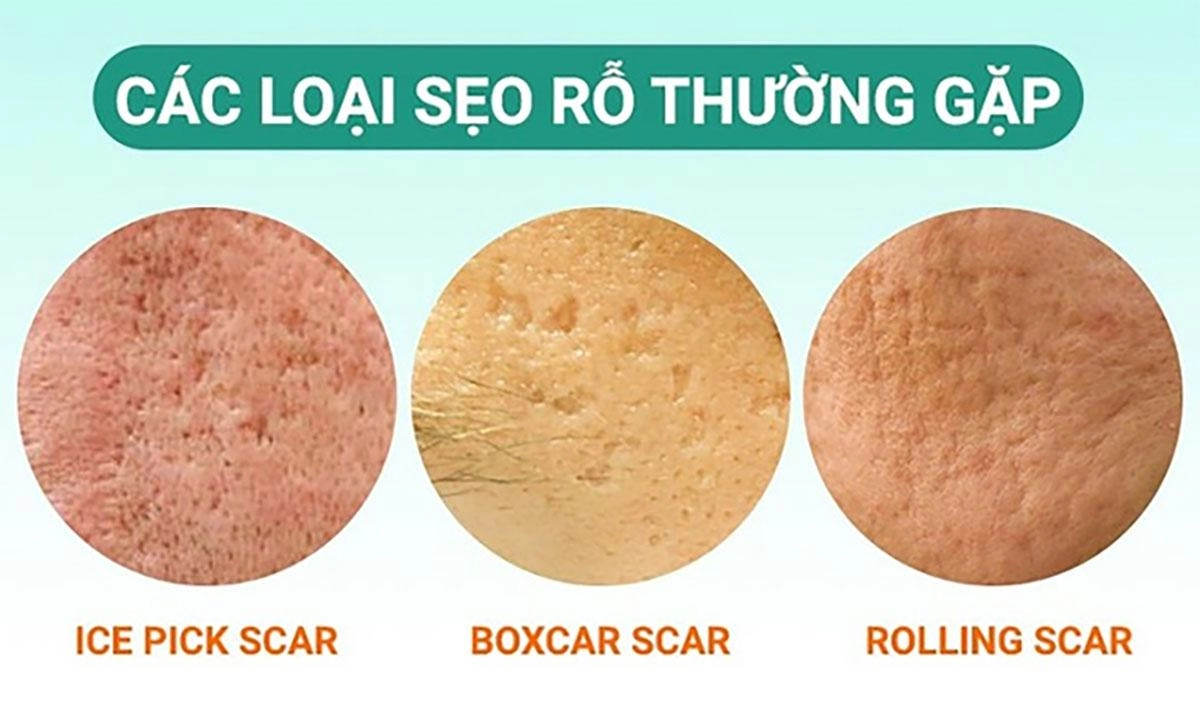 Collagen trị sẹo lõm được không? Cách uống hiệu quả