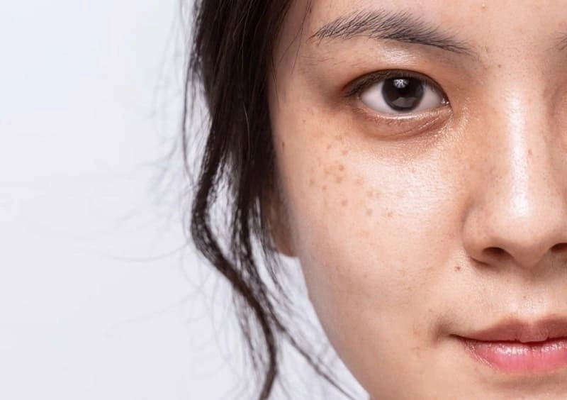 Trị Nám Chân Đinh: Nguyên Nhân Và Dấu Hiệu Nhận Biết