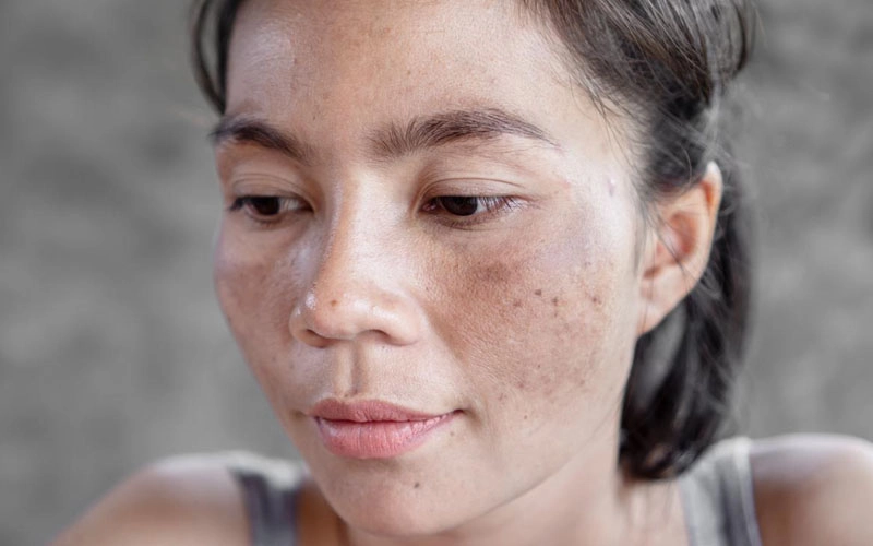 Nám Mảng Là Gì? Nguyên Nhân Và 5 Cách Điều Trị Hiệu Quả