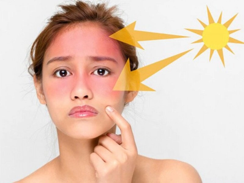 Nguyên Nhân Gây Nám Tàn Nhang và Cách Điều Trị Hiệu Quả