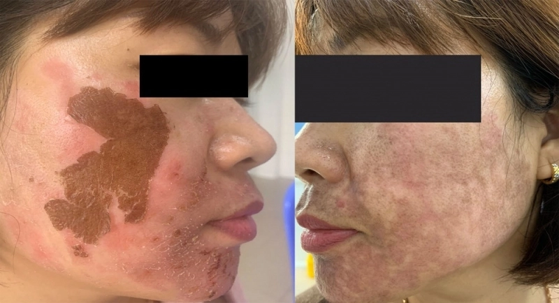 Tác Hại Của Việc Trị Nám Bằng Laser: Những Điều Bạn Cần Biết