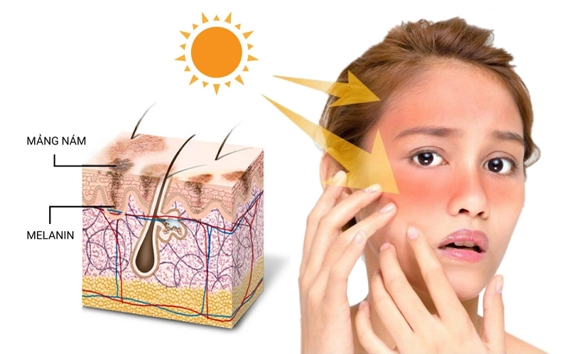 Cơ Chế Hình Thành Nám Da Và Cách Khắc Phục